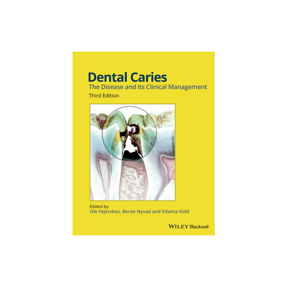 John Wiley And Sons Ltd Dental Caries (inbunden, eng)