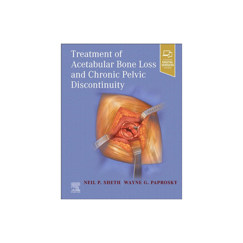 Elsevier - Health Sciences Division Treatment of Acetabular Bone Loss and Chronic Pelvic Discontinuity (inbunden, eng)