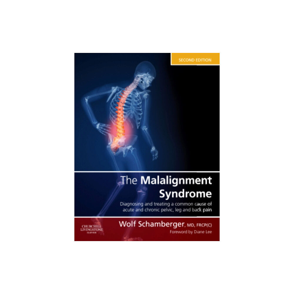 Elsevier Health Sciences The Malalignment Syndrome (inbunden, eng)