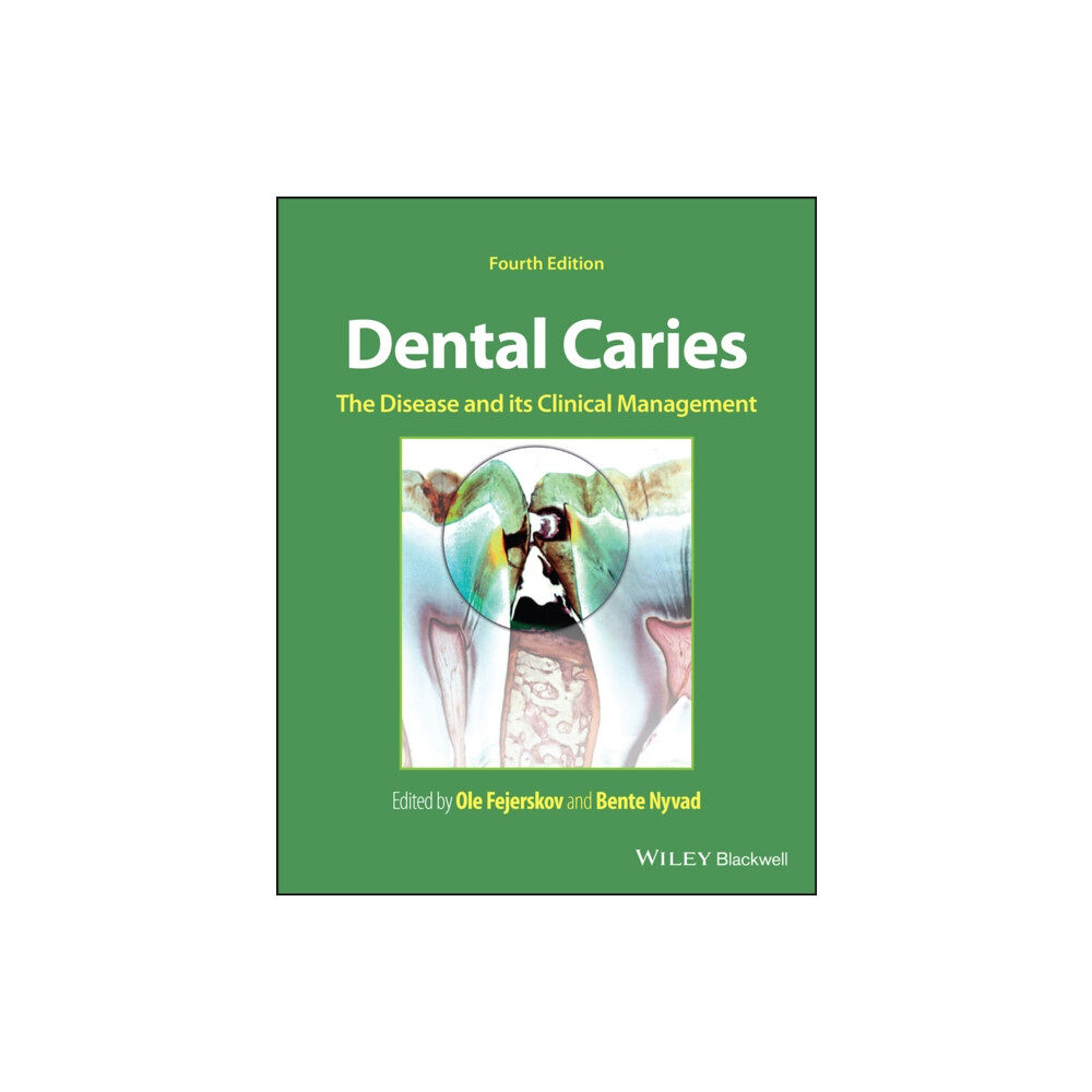 John Wiley And Sons Ltd Dental Caries (inbunden, eng)