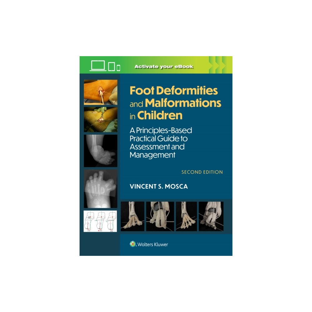 Wolters Kluwer Health Foot Deformities and Malformations in Children (inbunden, eng)