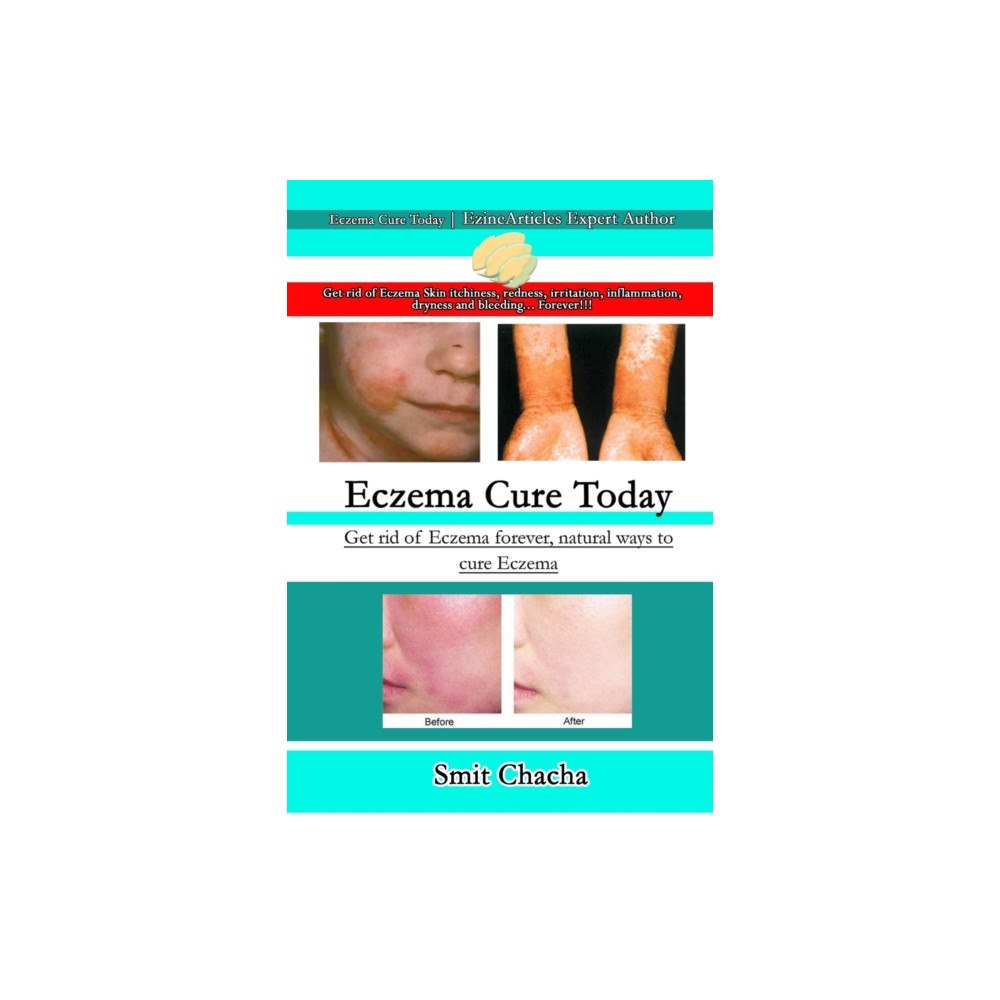 Lulu.com Eczema Cure Today - Get rid of Eczema forever natural ways to cure Eczema (häftad, eng)