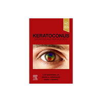 Elsevier - Health Sciences Division Keratoconus (häftad, eng)